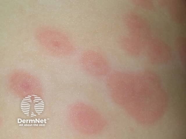 Targetoid lesion in Finkelstein vasculitis