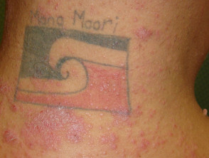 Tattoo-associated skin reactions | DermNet