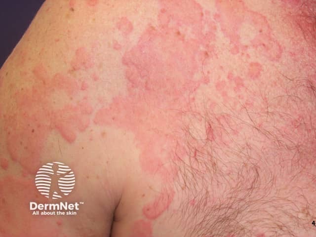 Urticaria from nonsteroidal anti-inflammatory drug