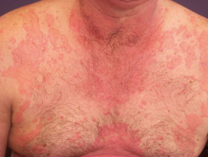 Skin Rash, Urticaria, Allergic Skin Reaction. Stock Image - Image of  allergist, irritated: 93000603
