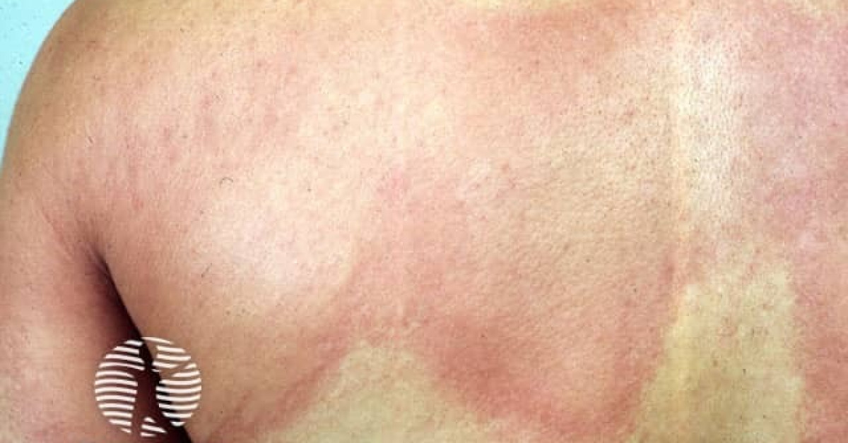 Urticaria Image urticaria-image