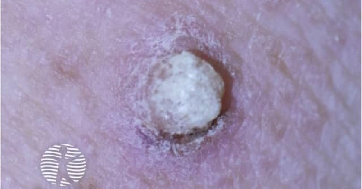 DermNet® - Papilloma due to vemurafenib image