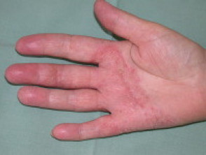 vesicular hand dermatitis s