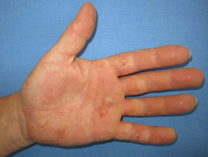 Hand dermatitis due to rubber glove allergy