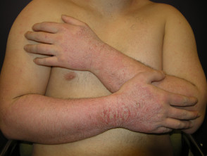 Contact dermatitis: allergy to gloves