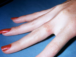 Dermatitis under a nickel-containing ring