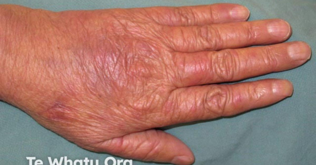 Dorsal handfoot syndrome due to chemotherapy image