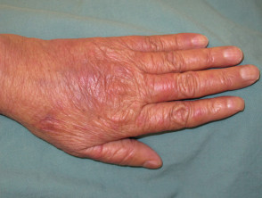 Dorsal hand-foot syndrome due to chemotherapy