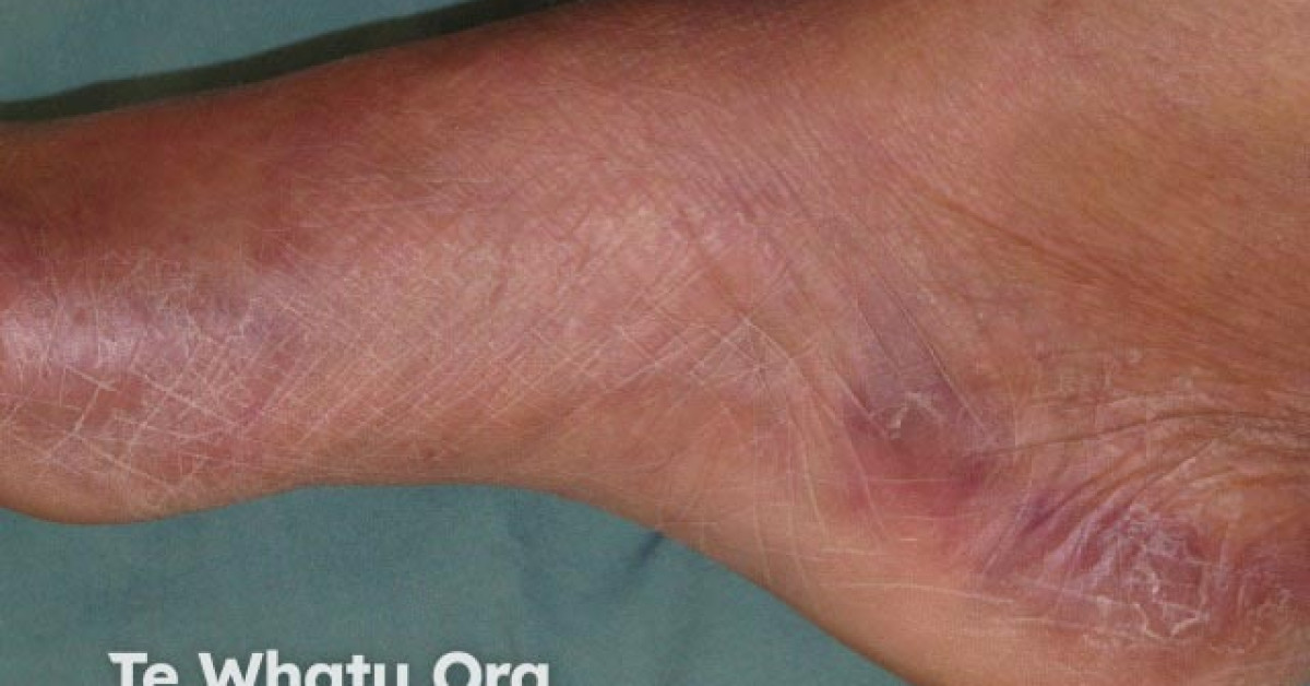 Handfoot syndrome due to chemotherapy image