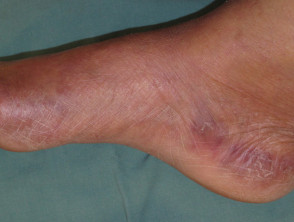 Hand-foot syndrome due to chemotherapy