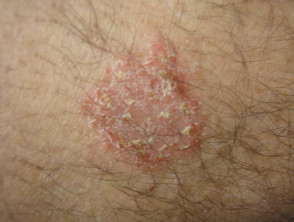 Nummular dermatitis