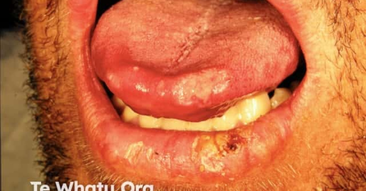 Oral squamous cell carcinoma image