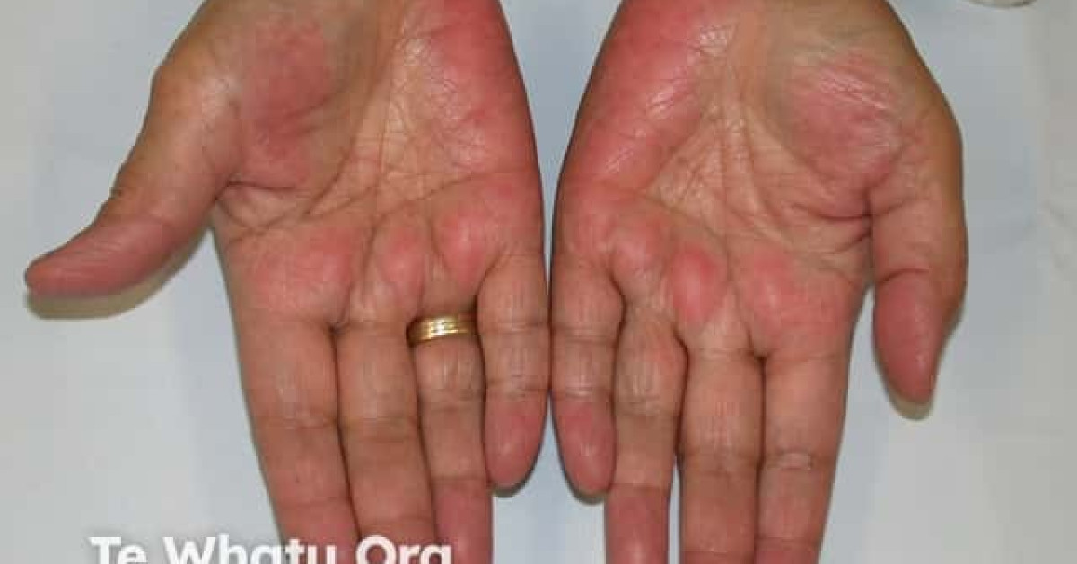 DermNet® - Palmar erythema image