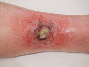 Acute radiation dermatitis
