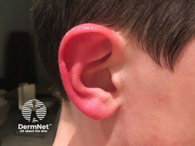 Primary erythromelalgia-type red ear syndrome in a child