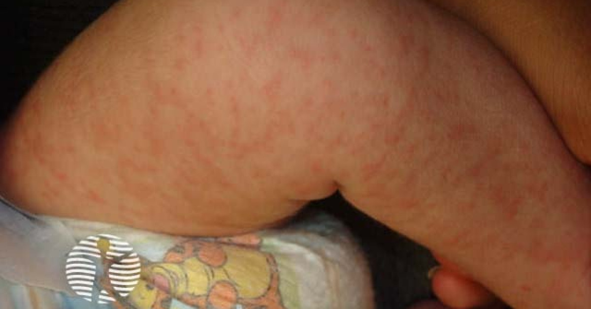 Rosella Rash Time Course Roseola image