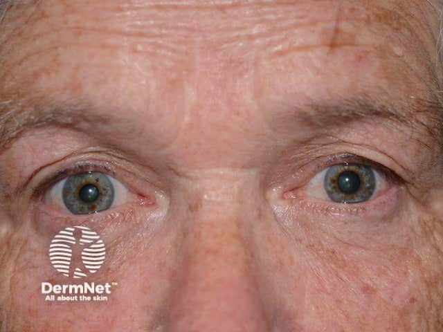 Anisocoria in Ross syndrome