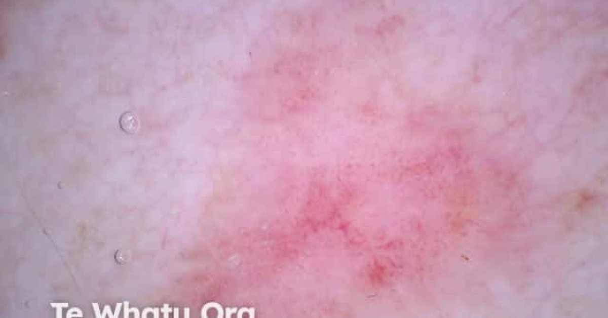 Superficial basal cell carcinoma dermoscopy image