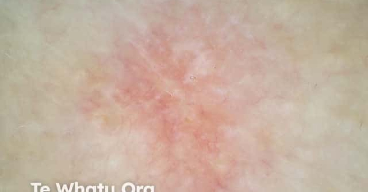 Superficial basal cell carcinoma dermoscopy image