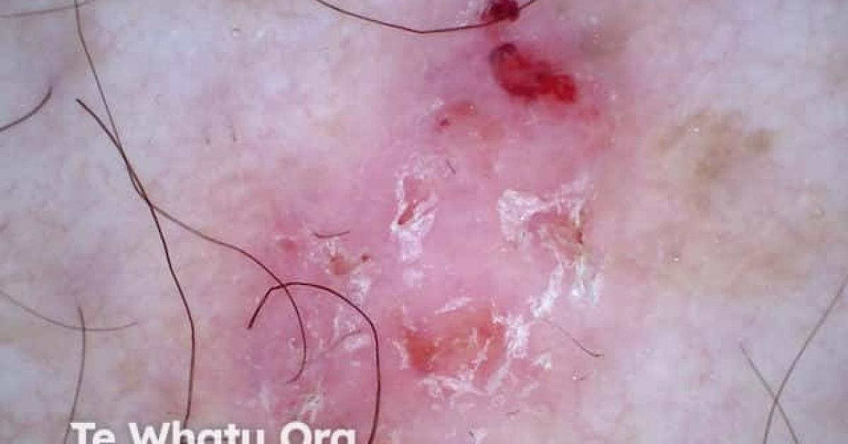 Superficial basal cell carcinoma dermoscopy image