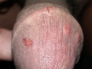 Penile papules due to scabies