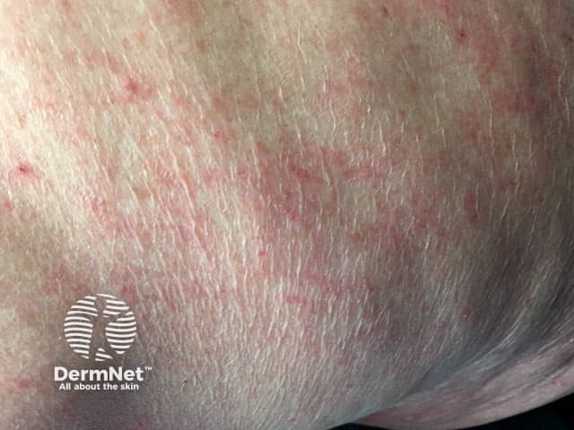 Nonspecific scabies rash