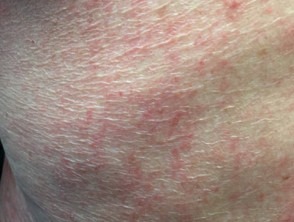 Nonspecific scabies rash