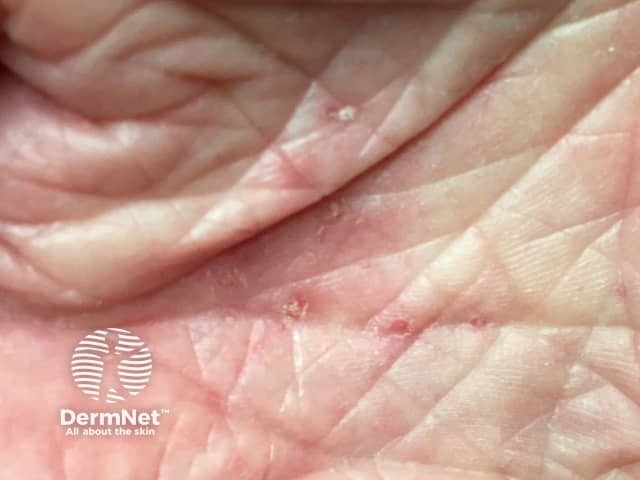 Palmar burrows due to scabies