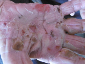 Infected burrows in crusted scabies