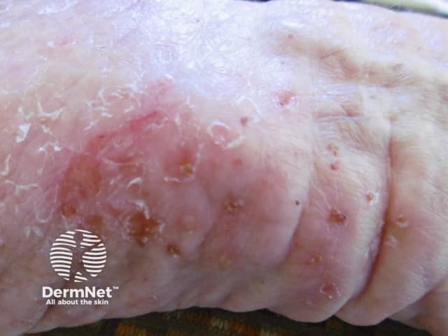 Excoriations in scabies