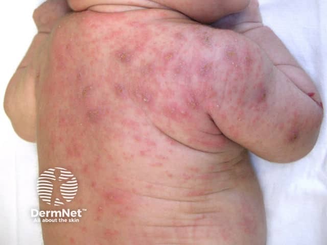 Scabies rash in an infant