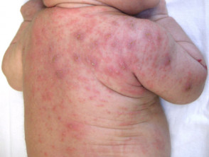 Scabies rash in an infant