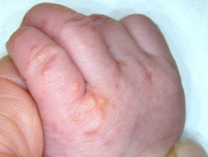 Scabies on the hand on an infant