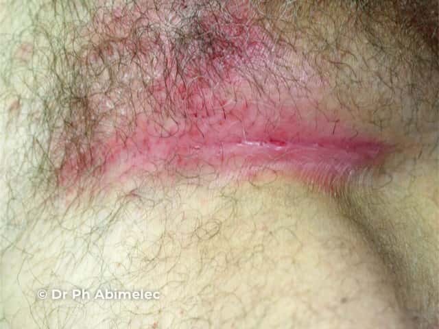 Well demarcated salmon pink erythema which extends to the apex of the skin fold due to flexural psoriasis