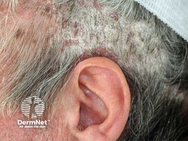 Well demarcated plaques of scalp psoriasis