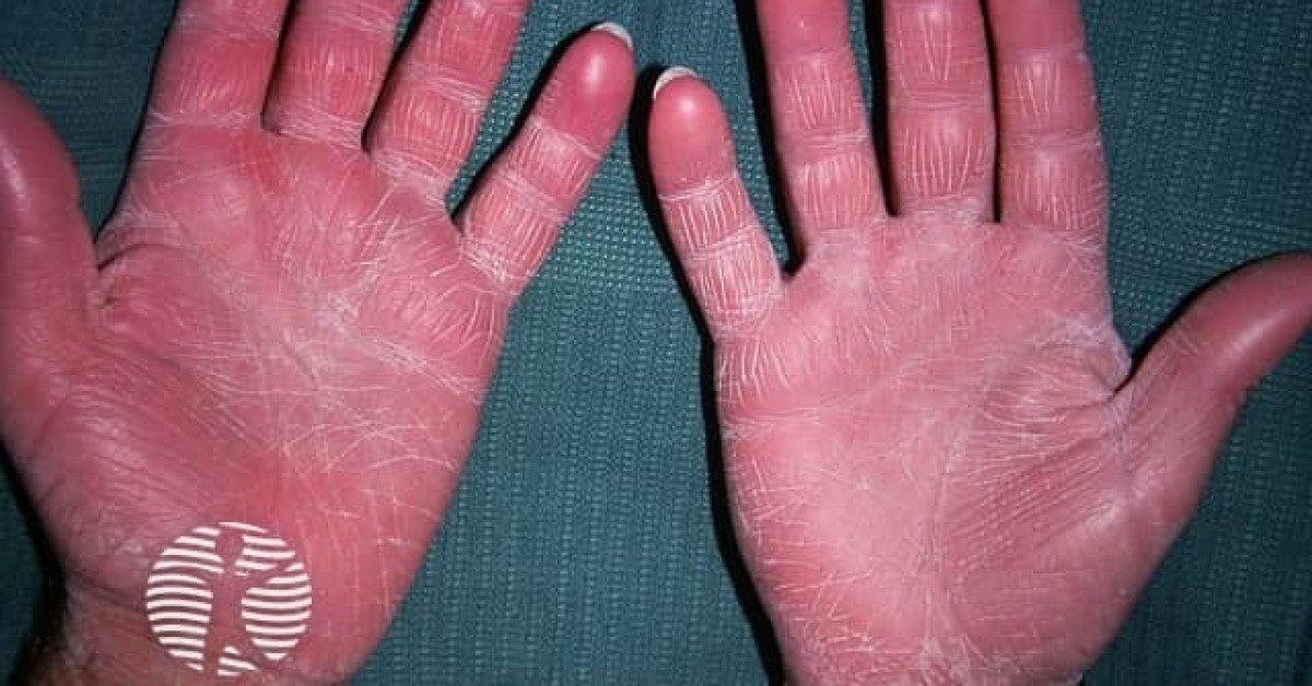 Acquired ichthyosis image