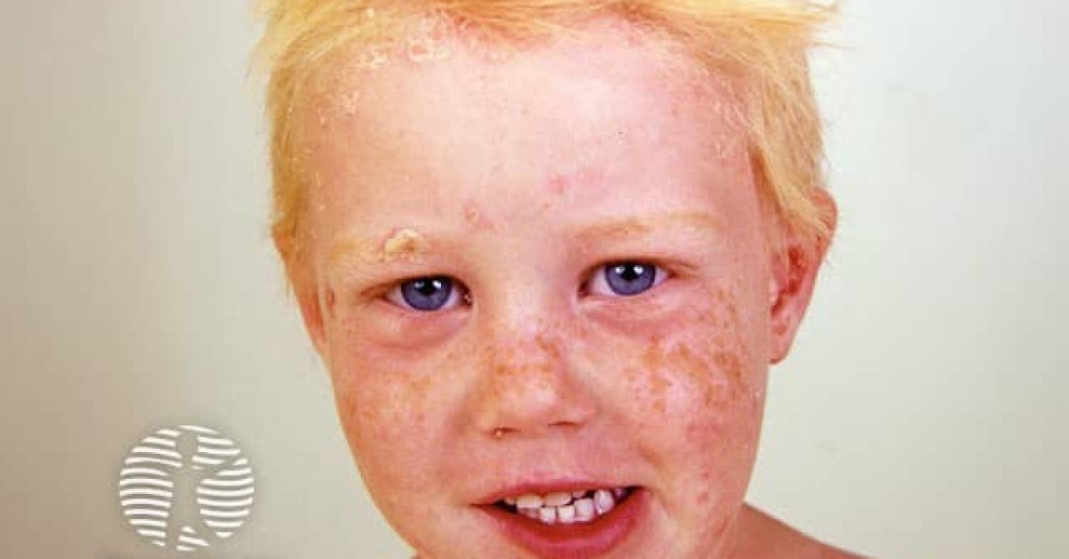 Facial psoriasis in child image