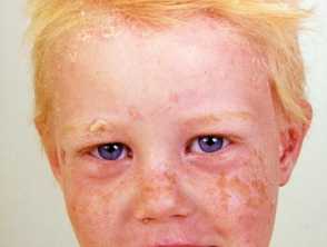 Facial psoriasis in child