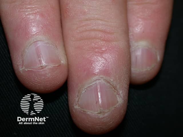 V-nick and red streaks in fingernails