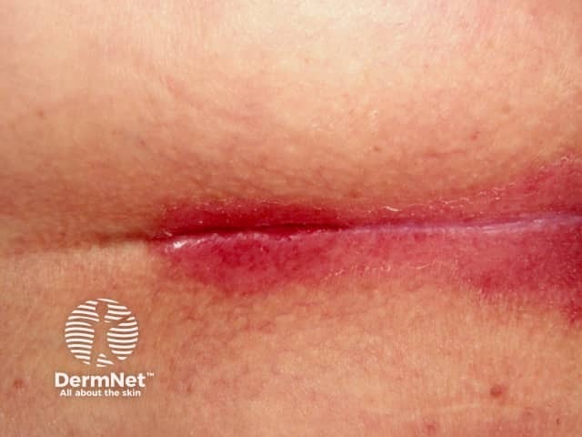 Well demarcated salmon pink erythema which extends to the apex of the skin fold and into the natal cleft due to flexural psoriasis