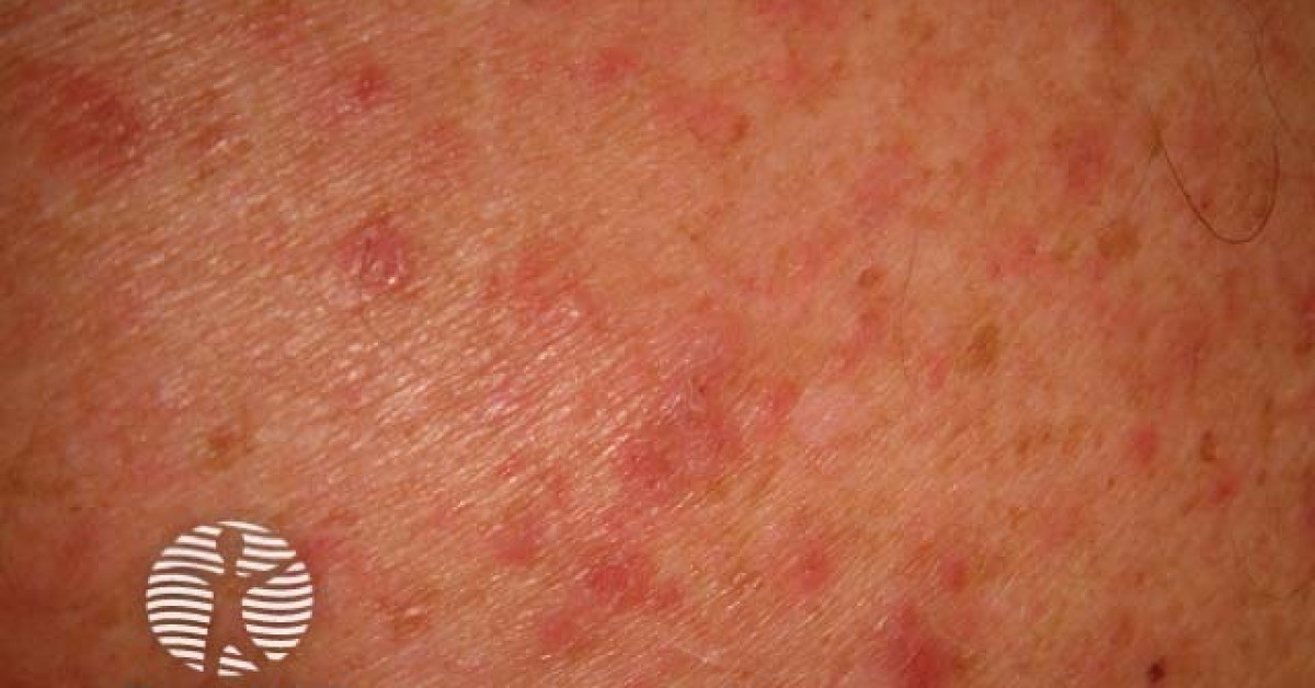 Grover disease image