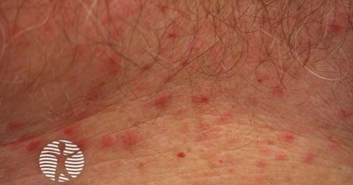 Grover disease image