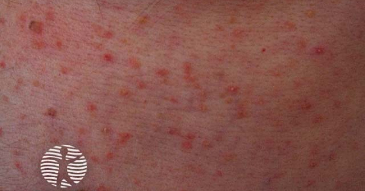 Grover disease image