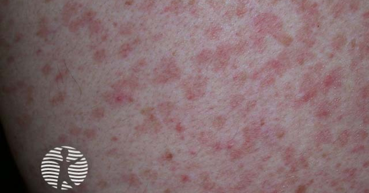 Grover disease image