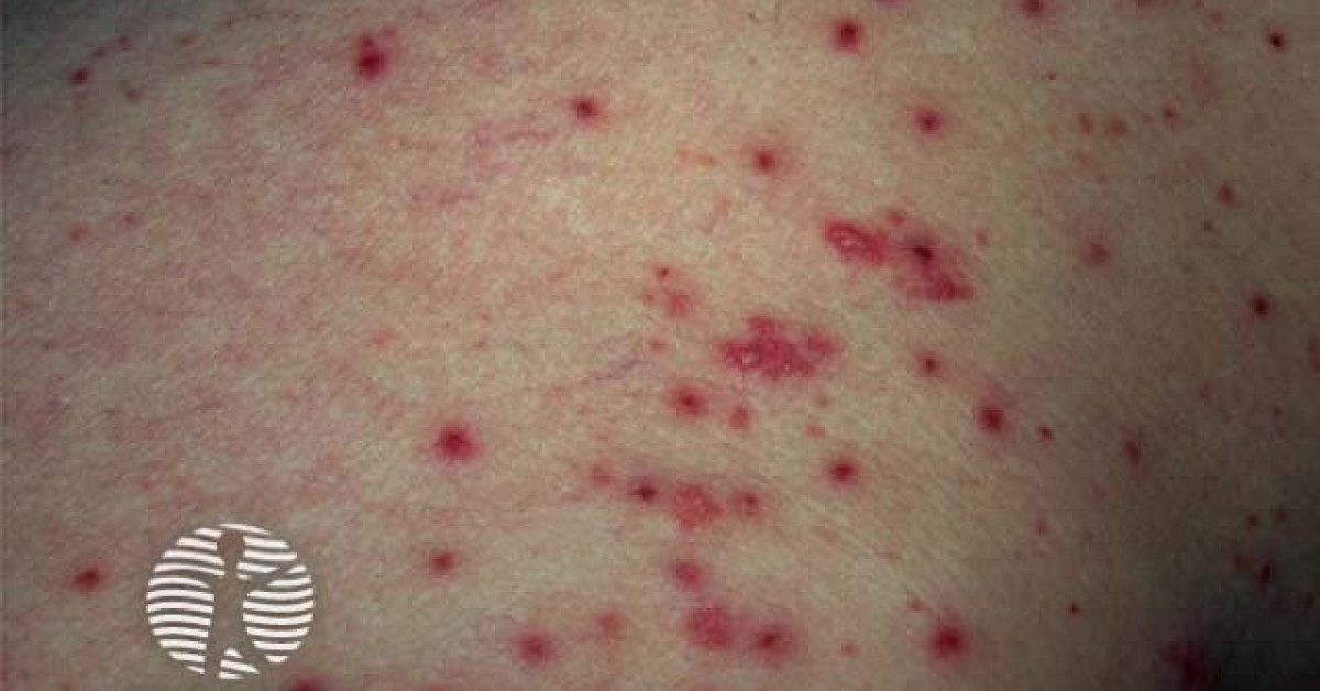 Grover disease image