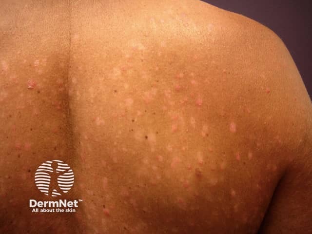 Small plaque psoriasis on the trunk in skin of colour - there is postinflammatory hypopigmentation