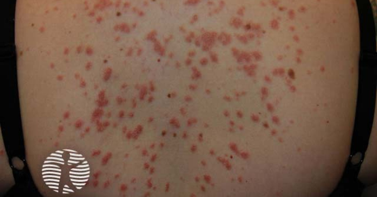 guttate-psoriasis-image