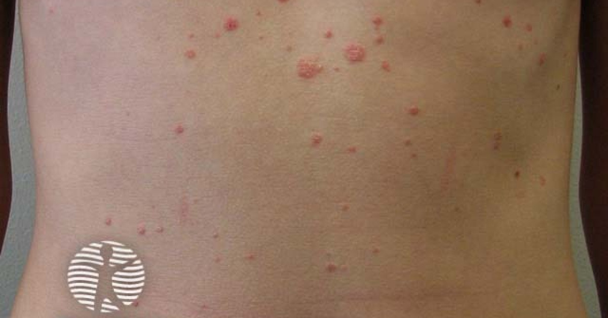 guttate-psoriasis-image