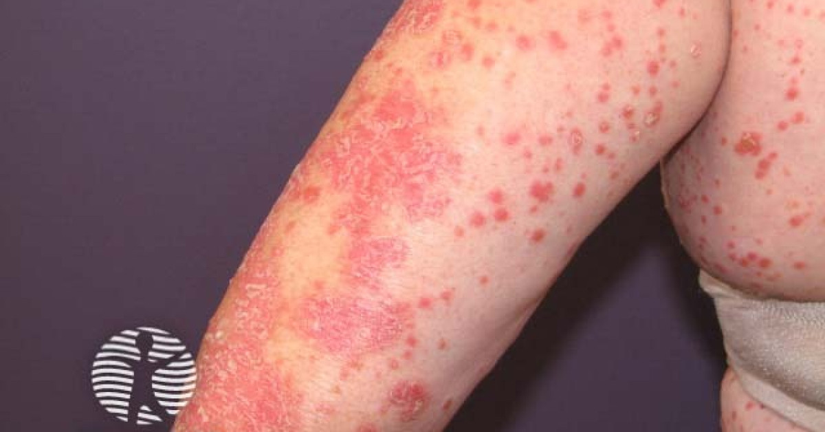 Guttate psoriasis image