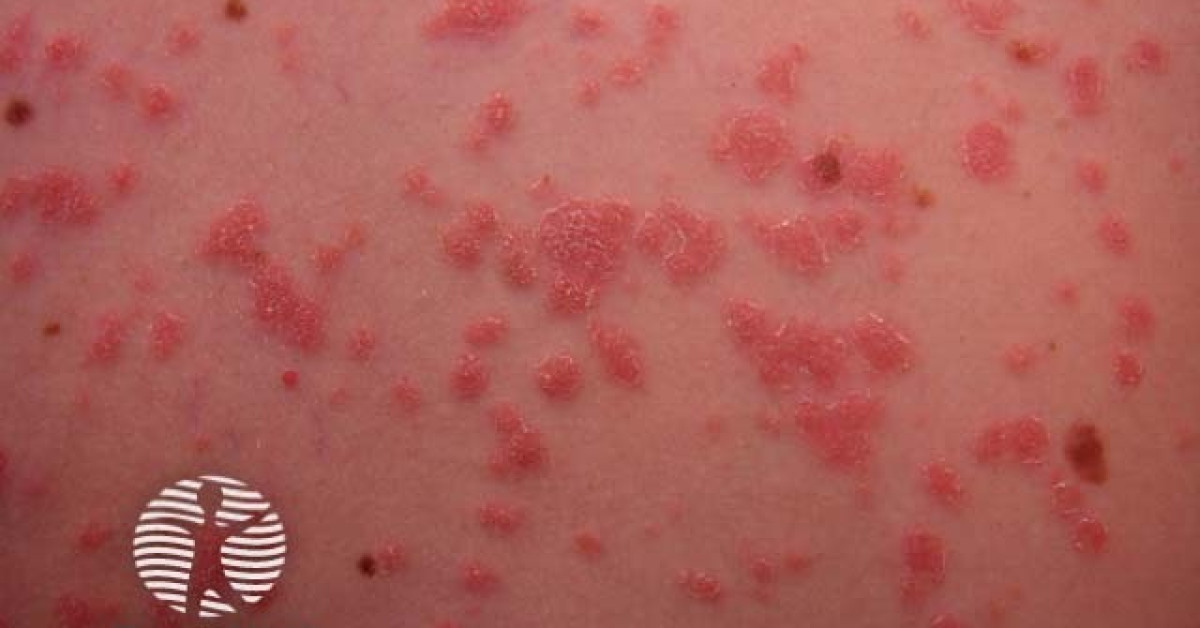Guttate psoriasis image